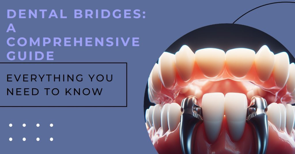 Dental Bridges A Comprehensive Guide