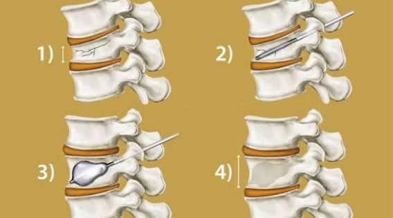 Vertebroplasty and Kyphoplasty Recovery Time in the Elderly: What to Expect