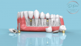 Full Mouth Dental Implants vs. Dentures: A Comprehensive Comparison (DOCTORPREM)