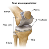 Knee Replacement Implants Market Growth, Trends And Forecast 2019 – 2026