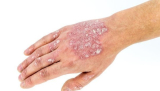 Guide to Juvederm and Basal Cell Carcinoma Treatment in Southern California