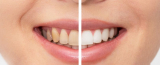 Cost of Teeth Whitening in Andheri, Mumbai