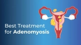 Understanding the Cost of Adenomyosis Surgery: A Comprehensive Guide
