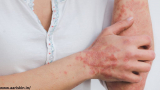 Psoriasis – Diagnosis And Treatment