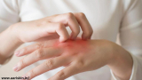 Fungal infections: Symptoms, types, and treatment
