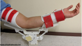 Outcomes And Factors Of Elbow Arthroscopy